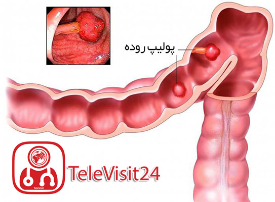 پولیپ روده چیست؟