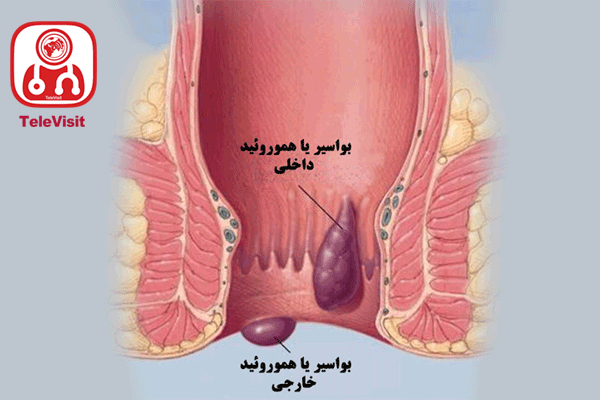 بیماری هموروئید و علل آن