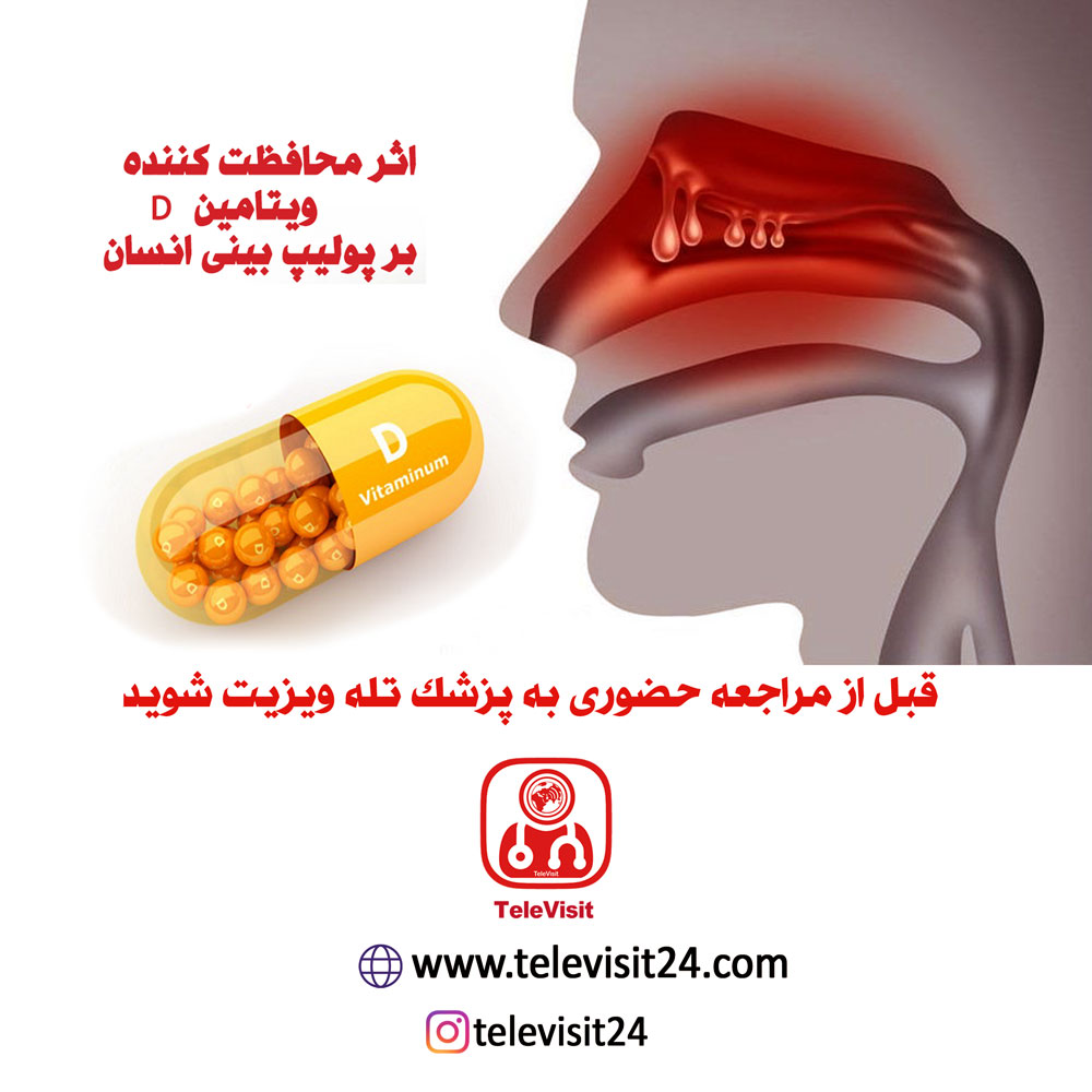 اثر محافظت کننده ویتامین D بر پولیپ بینی انسان