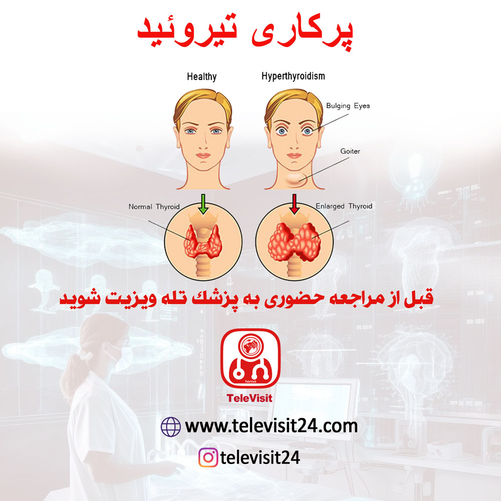 پرکاری تیروئید