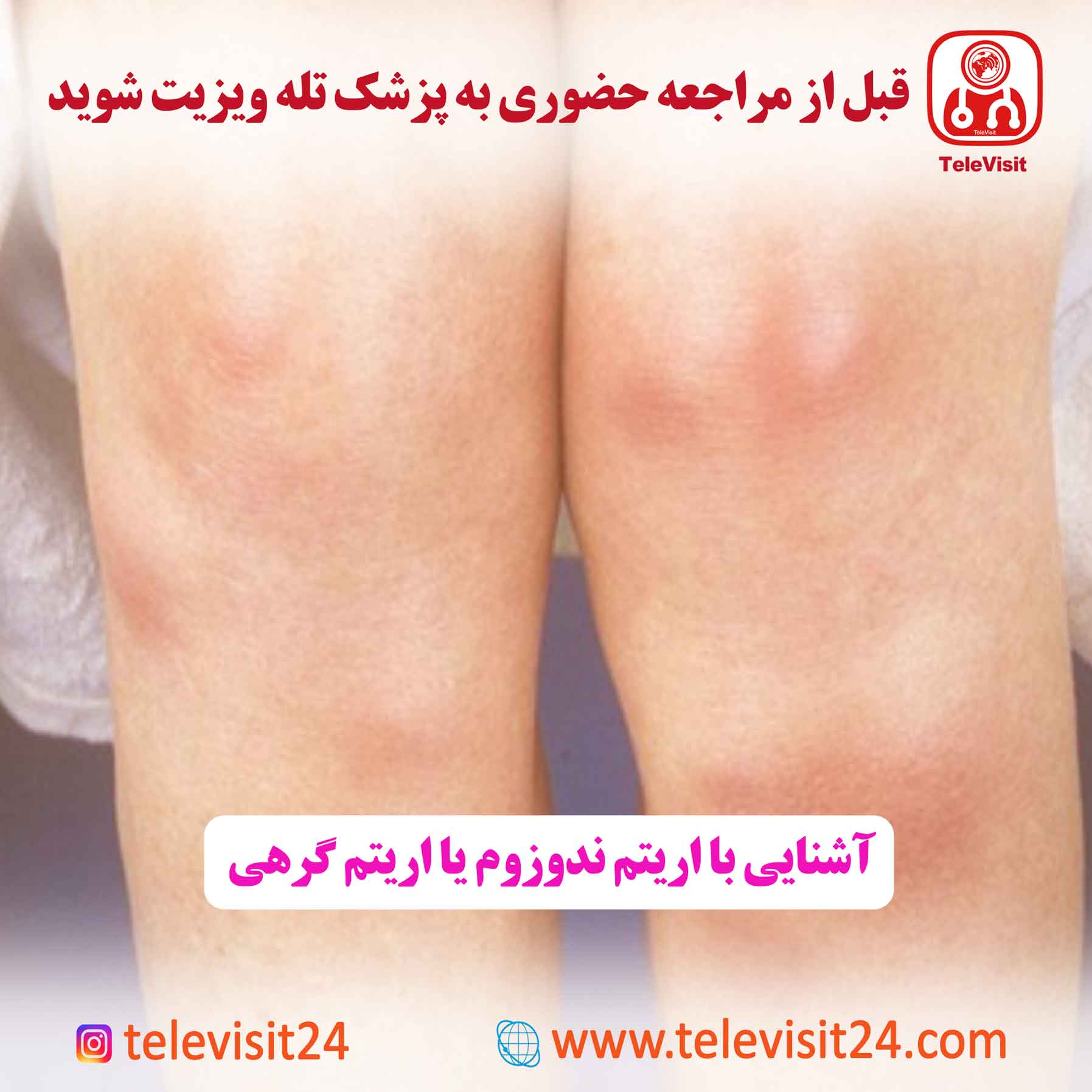 آشنایی با اریتم ندوزوم یا اریتم گرهی
