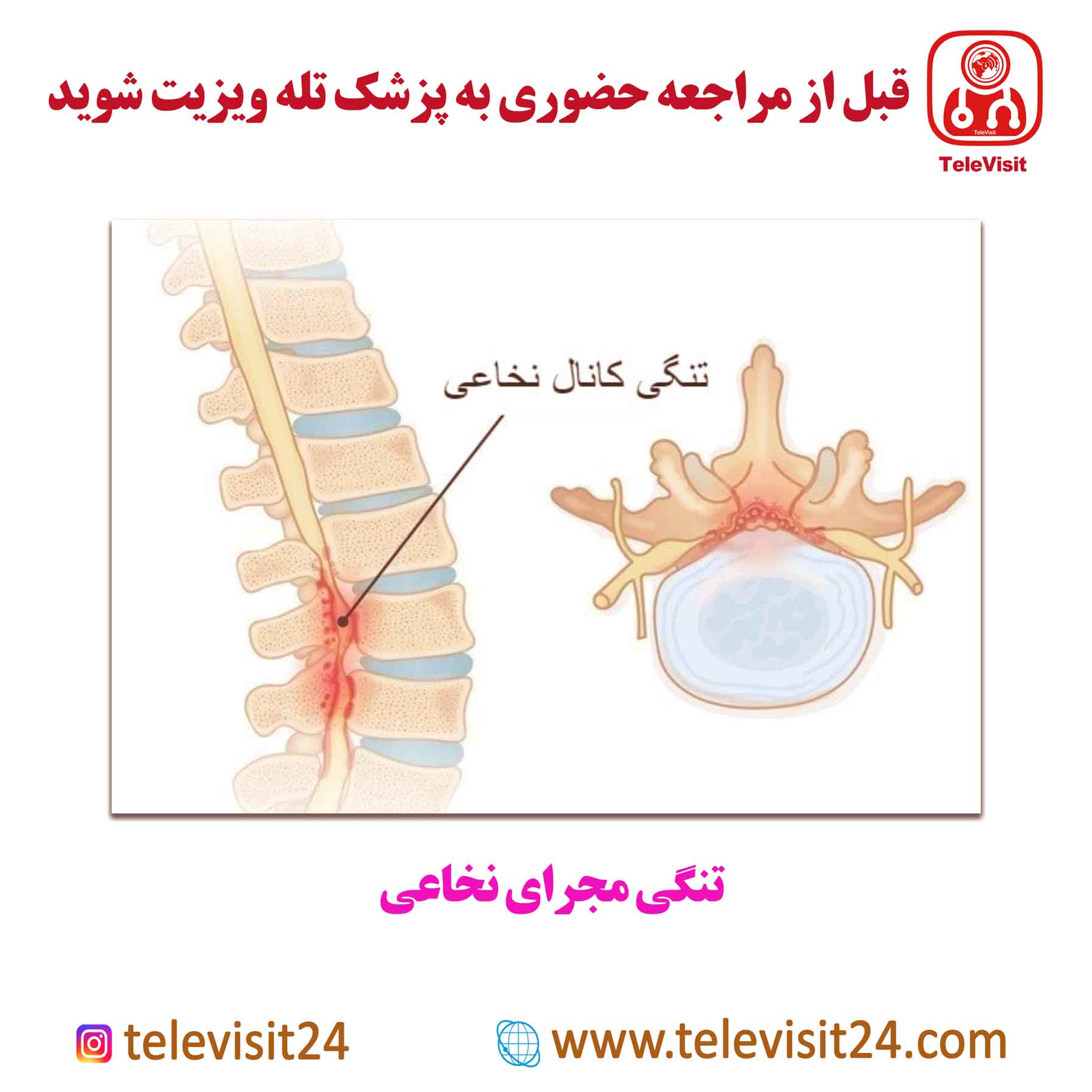 تنگی مجرای نخاعی 