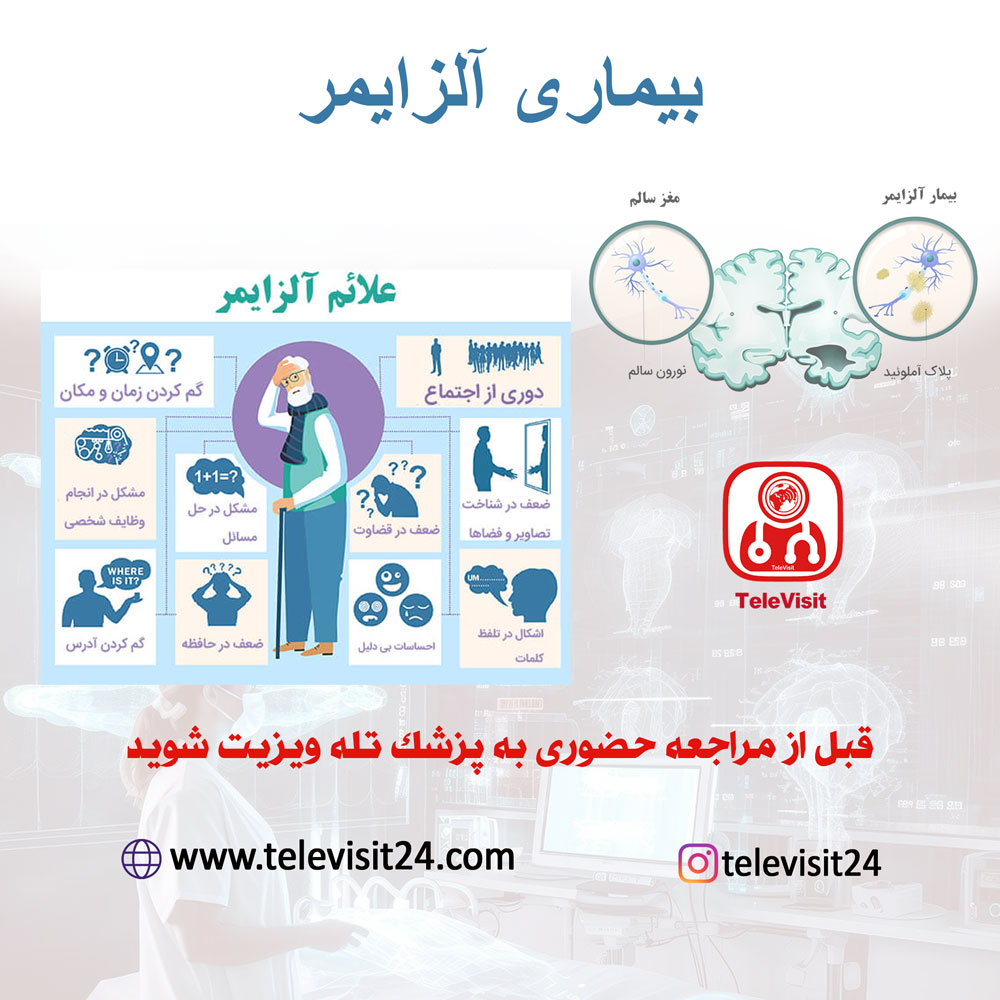 بیماری آلزایمر
