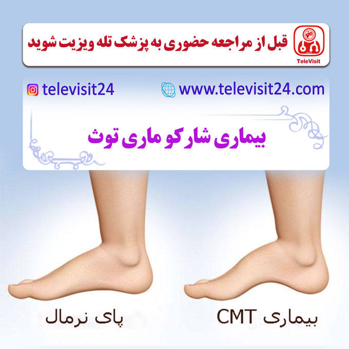 بیماری شارکو ماری توث