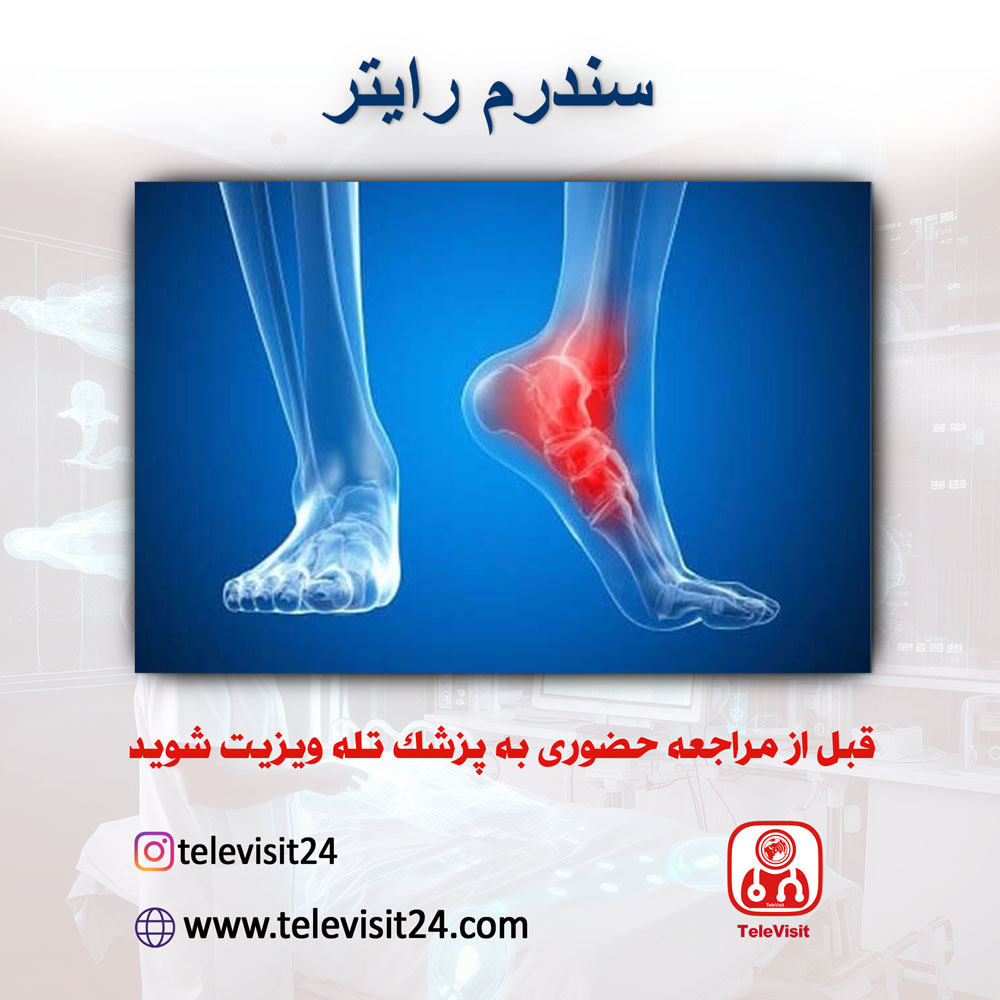 سندرم رایتر