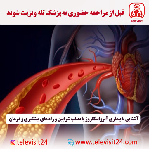 آشنایی با بیماری آترواسکلروز یا تصلب شرایین و راه های پیشگیری و درمان 
