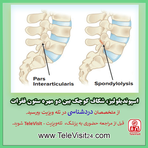 اسپوندیلولیز، شکاف کوچک بین دو مهره ستون فقرات