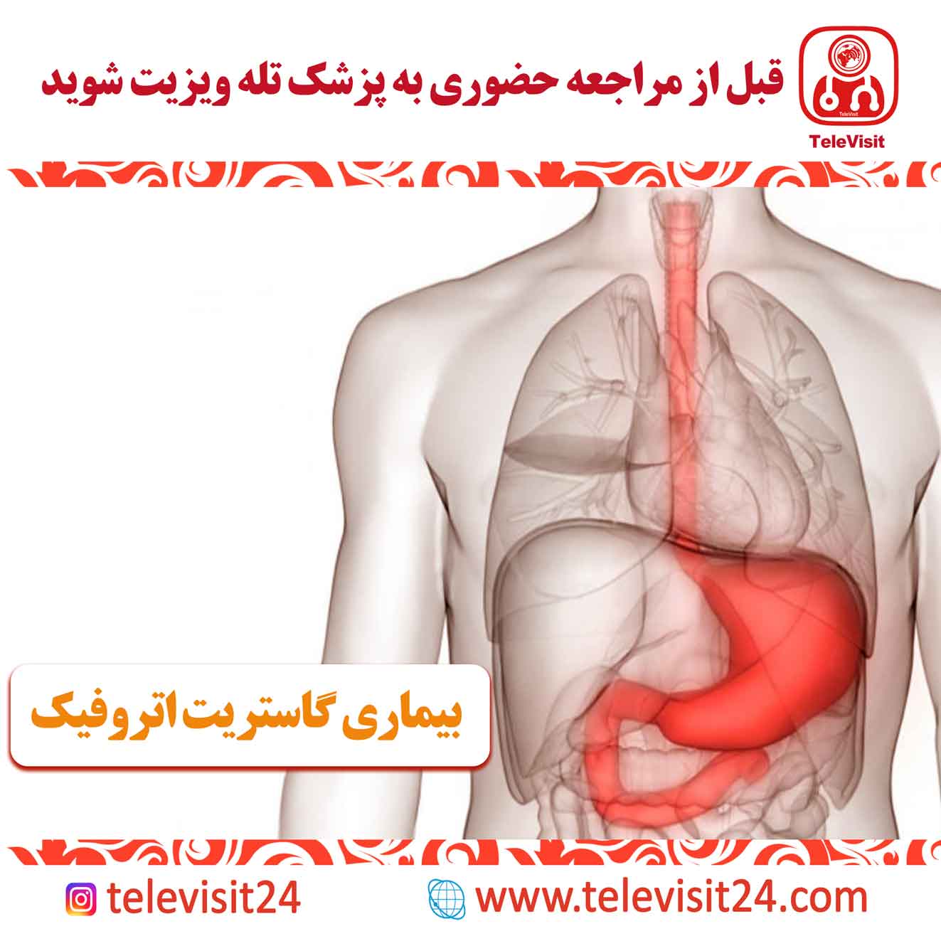 بیماری گاستریت اتروفیک
