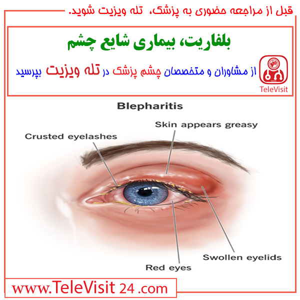 بلفاریت، بیماری شایع چشم