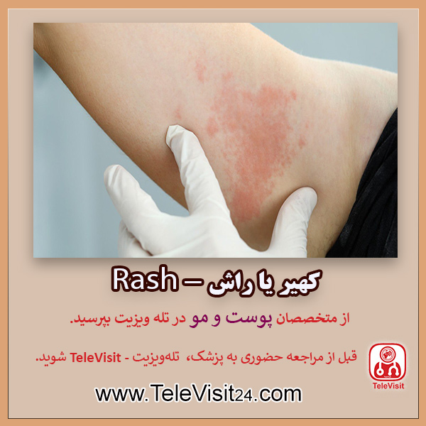 کهیر یا راش - Rash