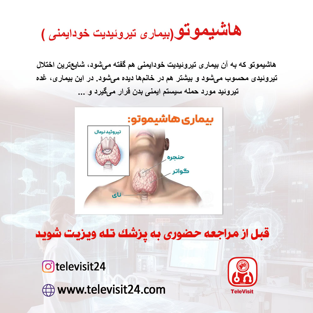 هاشیموتو
