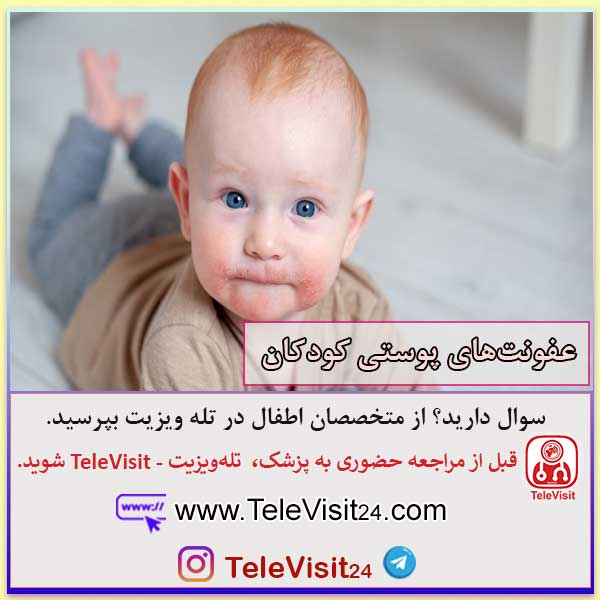 عفونت‌های پوستی کودکان