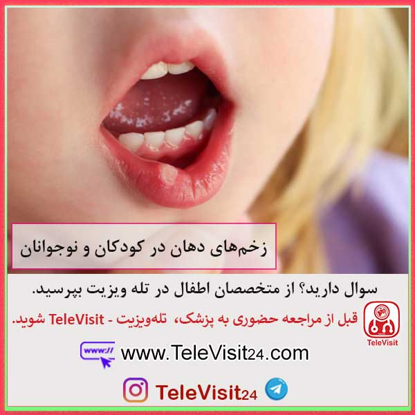 زخم های دهان در کودکان و نوجوانان