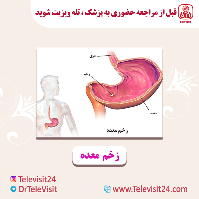 زخم معده