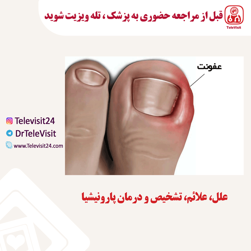 علل، علائم، تشخیص و درمان پارونیشیا 