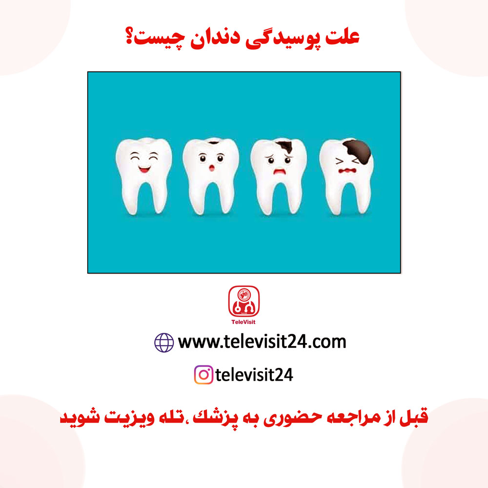 علت پوسیدگی دندان