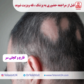 قارچ و کچلی سر