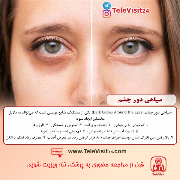 سیاهی دور چشم