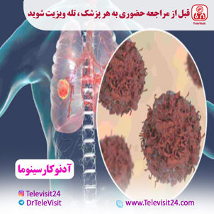 آدنوکارسینوما 