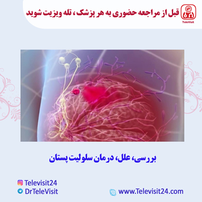 بررسی، علل، درمان سلولیت پستان